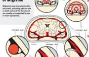 Neural Pathways of Migraine